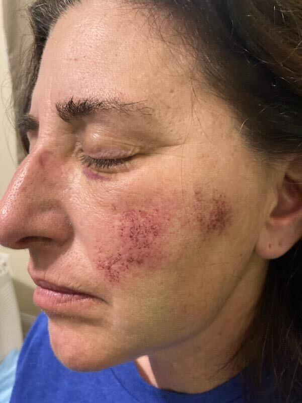 Naydich's bruised face after the attack.